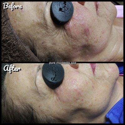 Nano Infusion Series - improves aging, pigmentation and scarring as well as overall texture and appearance of skin.