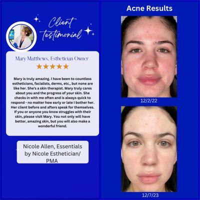 Acne client success and review