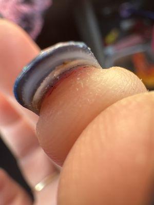 Crusty blood from being cut along my skin where the nail meets