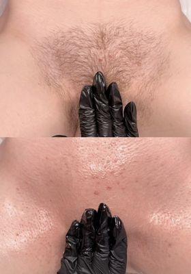 Before and after Brazilian wax