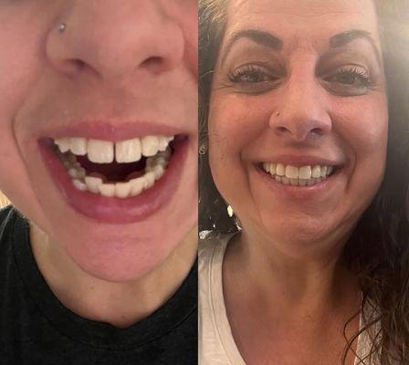 My results from Invisalign with Dr Molis