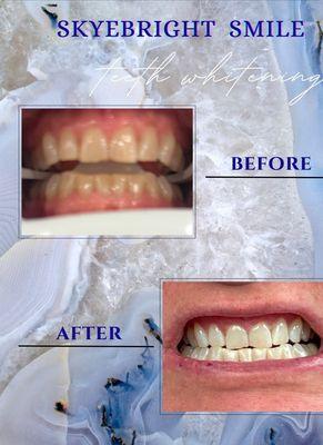 Before/After for 1 40 minute treatment