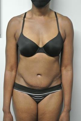 Postoperatively 5 mths, asymmetrical with more skin & stretch marks on left