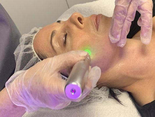 Microneedling in session
