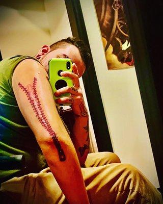 Zipper surrounding a massive scar of mine