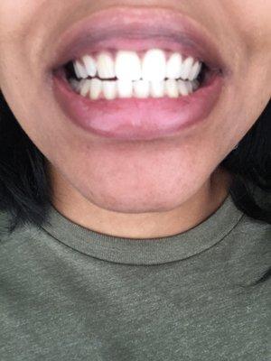 After my teeth cleaning! My teeth look good and feel great.