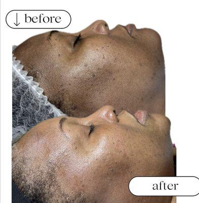 Chemical Peel