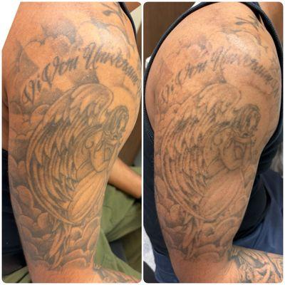 This is after one treatment, prior to my second. A few months had passed, as recommended to let the ink break down.