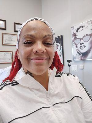 Laser Treatment for Melasma