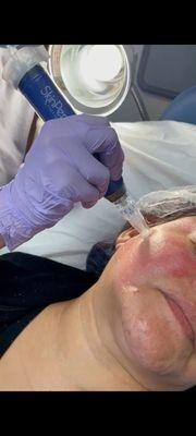 Getting my SkinPen treatment