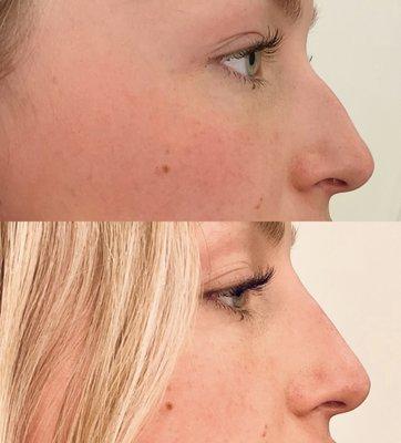 Before & After
Liquid Rhinoplasty