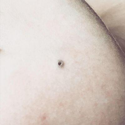 The problem... impacted blackhead.