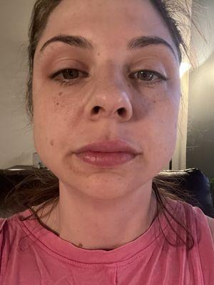 Scratch scar from micro needling and adding a peel