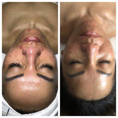 Dermasound Treatment