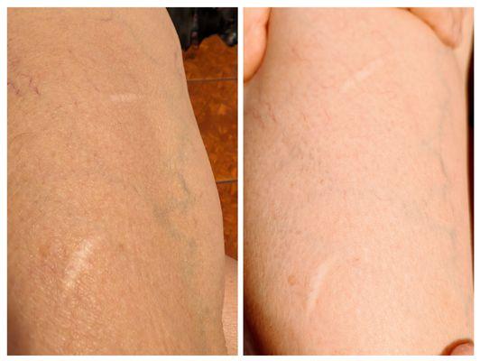 Scars lightened and smoother texture after 1 treatment