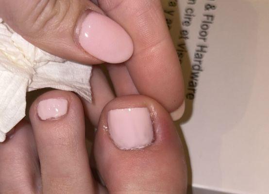 My whole toe is painful red and swollen