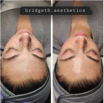 Before and after a hydro facial