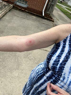 Brown recluse bite