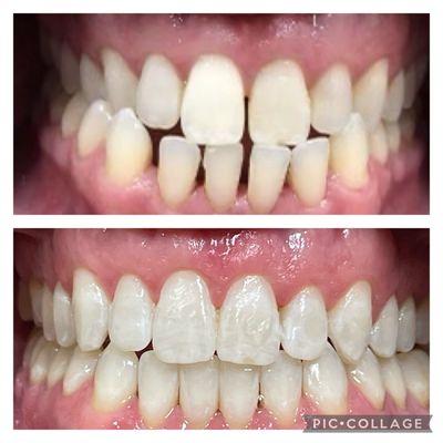 Invisalign before and after