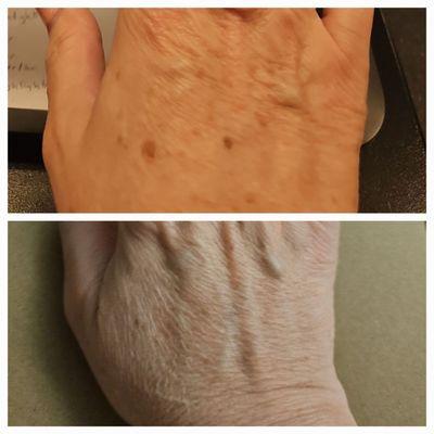 Before & After they removed these sun spots from my hand. I love the results. I couldn't be happier with them!