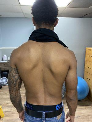 Before (shoulder blade)