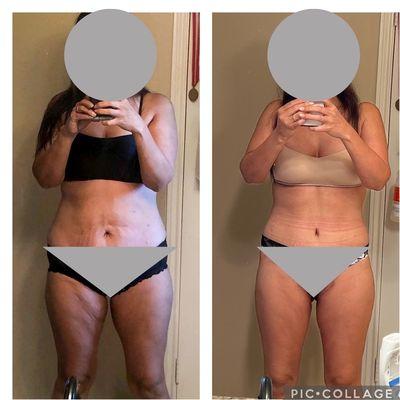 Before and after two rounds of plastics with Dr. Ellsworth after 80lb weightloss