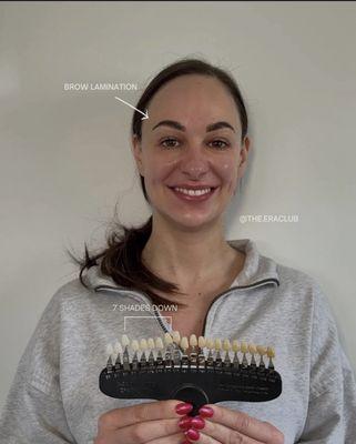 60 MINUTE TEETH WHITENING + BROW LAMINATION --we were able to achieve 7-shade difference !