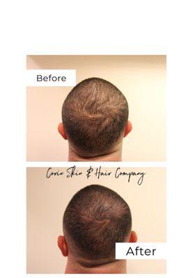 Micro Scalp Pigmentation