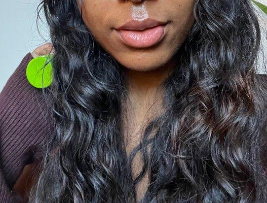 Front view 30 minutes After Injections