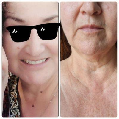 3 big skin tags remove and 2 months after wow~ great healed