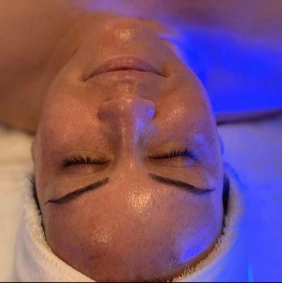 Love that glow following a HydraFacial!
