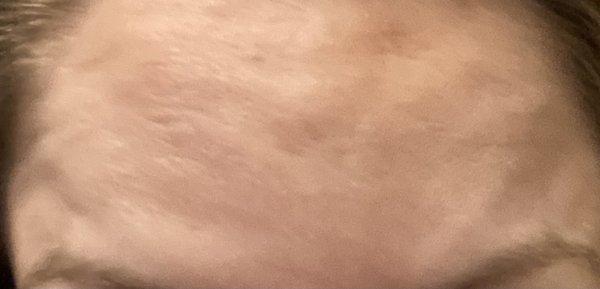 After 60 units of Botox at PureLee Redefined