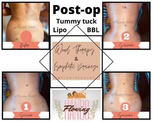 In home post op care. Client had a Tummy tuck, lipo, & BBL