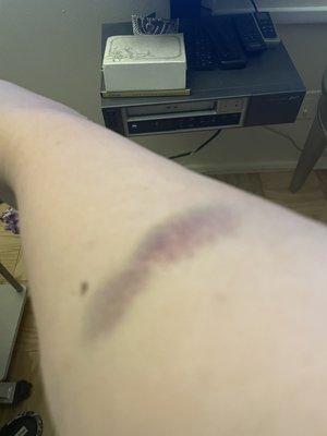 Horrible experience
This is the result of the massage