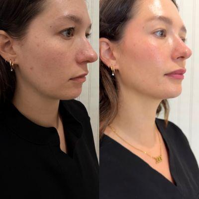 Juvederm Volux for sharp or subtle jawline definition.