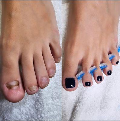 KeryFlex medical grade resin reconstruction.