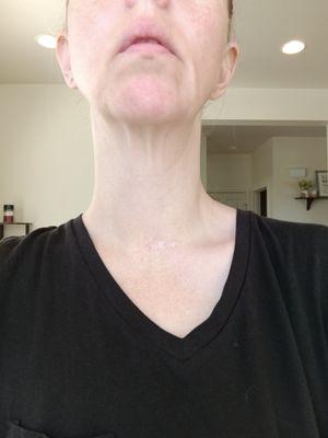 My small scar 1 yr after my neck surgery