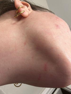 Dermaplane scratches