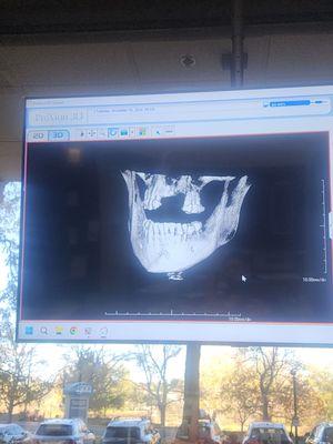Xray from new dentist showing how dr.miller broke my jaw bone off almost all the to my nose and he cant even call me back.