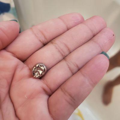 My daughter cap came off 2 days later but first it was her fill in