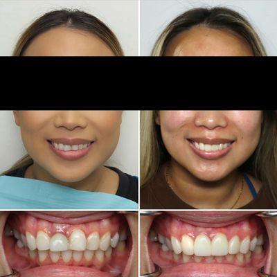 After this smile transformation, this patient can now show her teeth with confidence :)