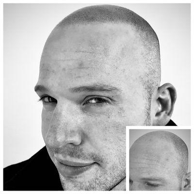 Precision Scalp Micropigmentation