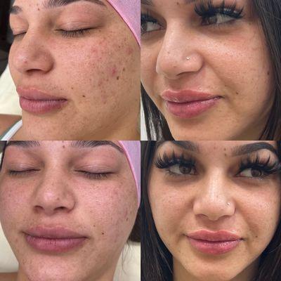 Client got the Angel Skin Package: results after alternating between glo2 oxygen facial and SkinPen microneedling