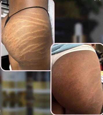 Stretch mark camouflage