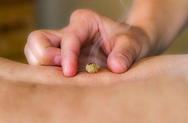 Moxibustion is a heat application technique used to warm and or activate the acupuncture points or areas on the acupuncture channels