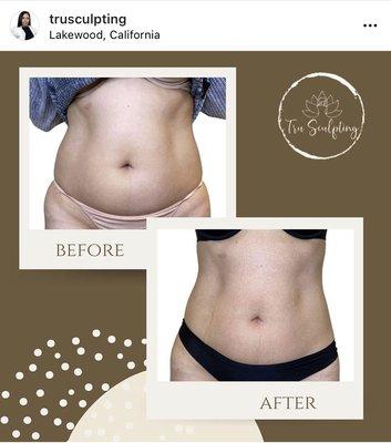 Tru Sculpting Health & Beauty
