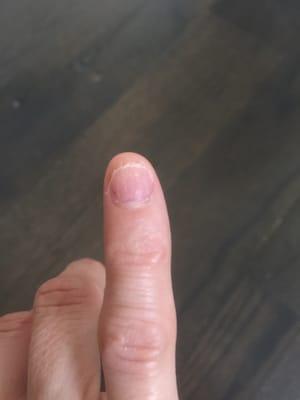 Nail infection. They need to clean their tools in between uses