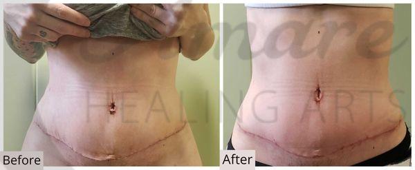 2 weeks post tummy tuck. 8 Manual Lymphatic Drainage sessions 8 days in a row.
