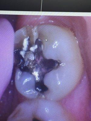 Cracked molar. Dr. Hawkins cautiously removed the broken piece and saved my tooth.