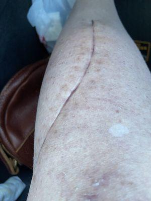 The scar I am left with
